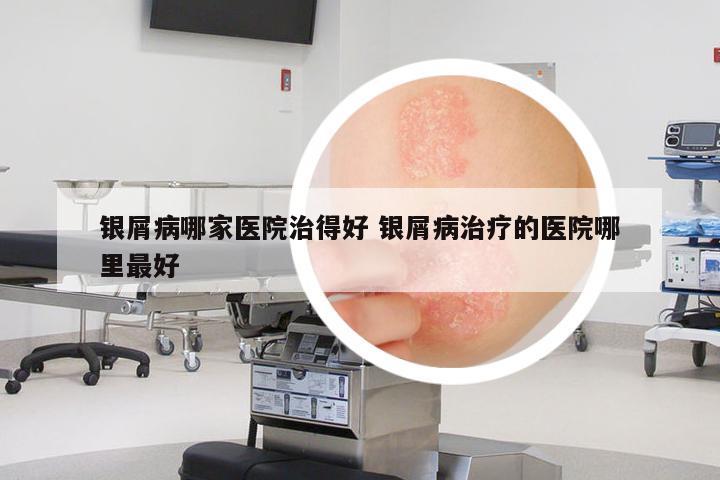 銀屑病哪家醫(yī)院治得好 銀屑病治療的醫(yī)院哪里最好