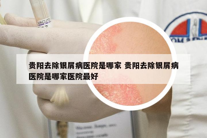 貴陽(yáng)去除銀屑病醫(yī)院是哪家 貴陽(yáng)去除銀屑病醫(yī)院是哪家醫(yī)院最好