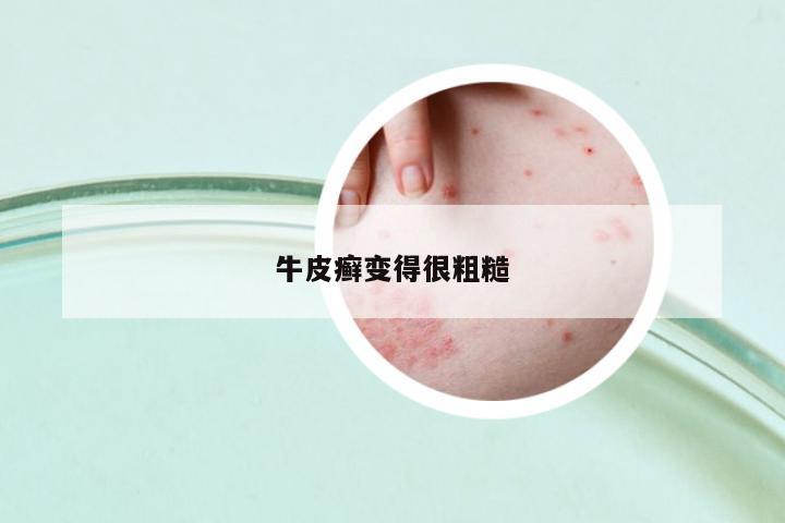 牛皮癬變得很粗糙