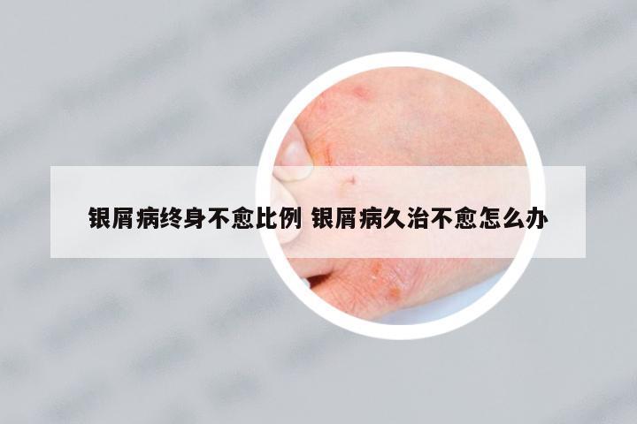 銀屑病終身不愈比例 銀屑病久治不愈怎么辦