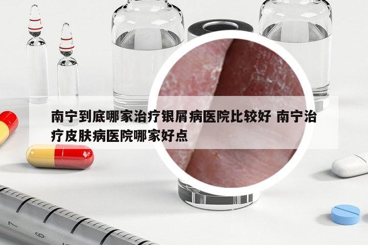 南寧到底哪家治療銀屑病醫(yī)院比較好 南寧治療皮膚病醫(yī)院哪家好點(diǎn)
