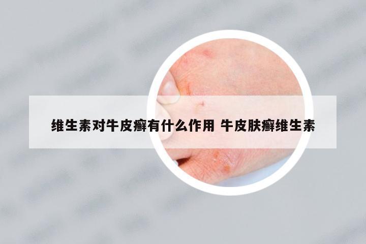 維生素對(duì)牛皮癬有什么作用 牛皮膚癬維生素
