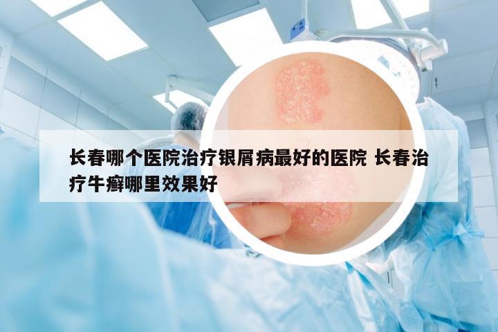 長春哪個(gè)醫(yī)院治療銀屑病最好的醫(yī)院 長春治療牛癬哪里效果好