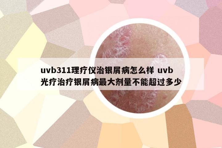 uvb311理療儀治銀屑病怎么樣 uvb光療治療銀屑病最大劑量不能超過(guò)多少