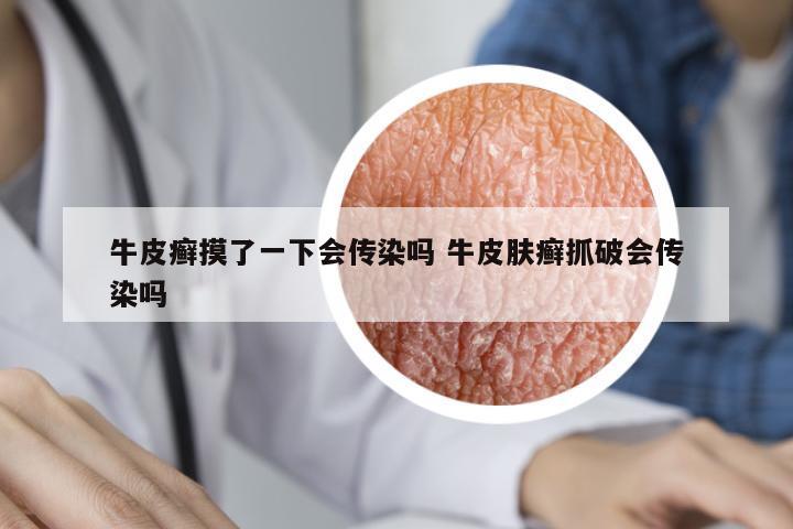 牛皮癬摸了一下會傳染嗎 牛皮膚癬抓破會傳染嗎