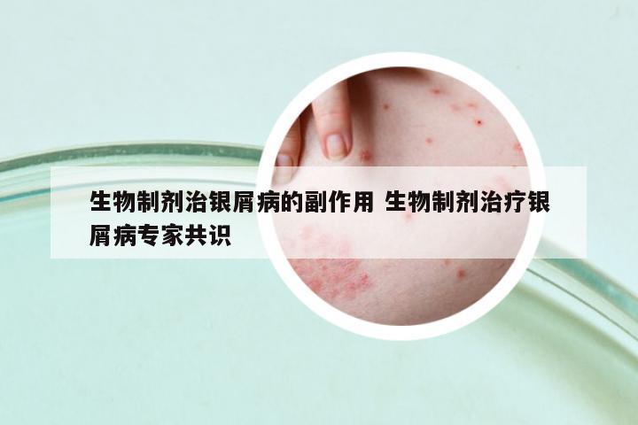 生物制劑治銀屑病的副作用 生物制劑治療銀屑病專家共識(shí)