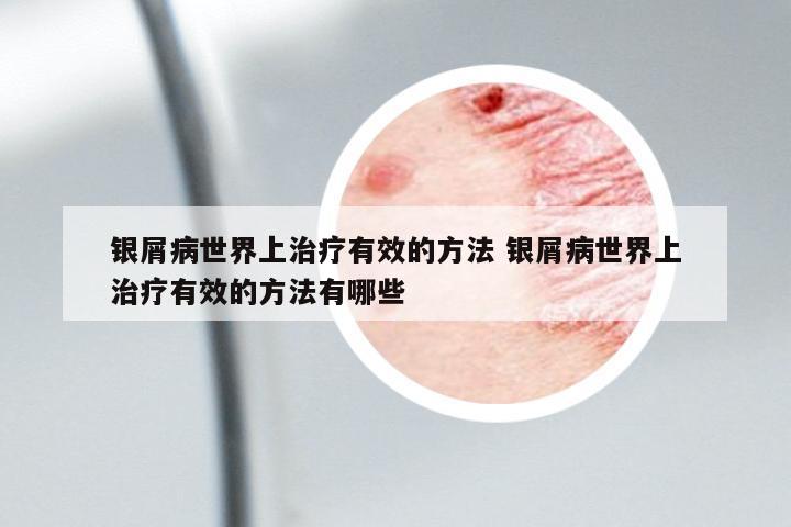 銀屑病世界上治療有效的方法 銀屑病世界上治療有效的方法有哪些