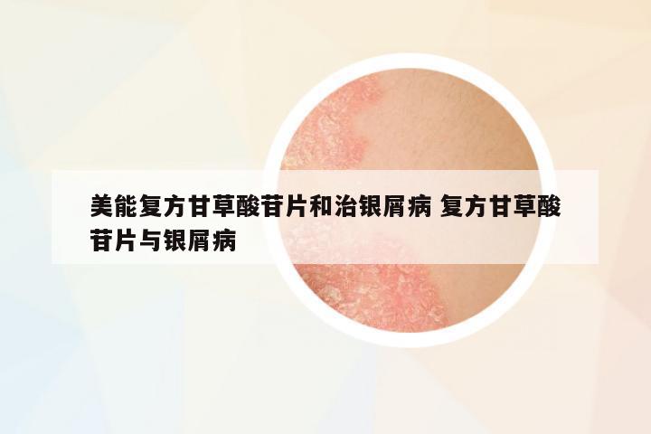 美能復(fù)方甘草酸苷片和治銀屑病 復(fù)方甘草酸苷片與銀屑病