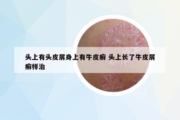 頭上有頭皮屑身上有牛皮癬 頭上長了牛皮屑癬樣治
