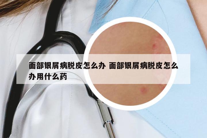 面部銀屑病脫皮怎么辦 面部銀屑病脫皮怎么辦用什么藥
