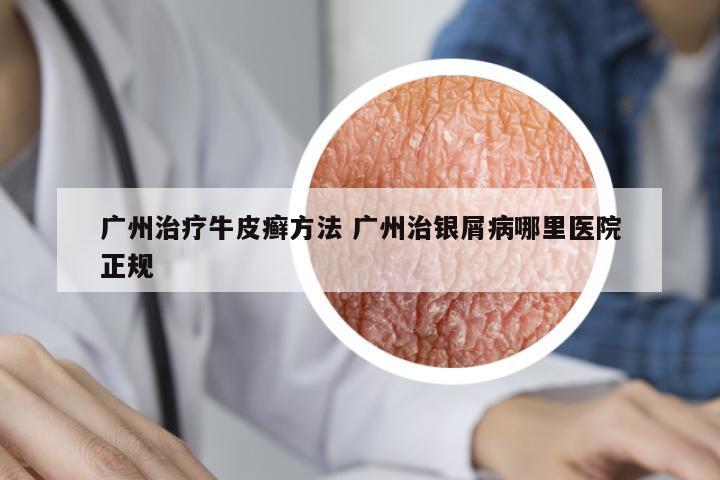 廣州治療牛皮癬方法 廣州治銀屑病哪里醫(yī)院正規(guī)