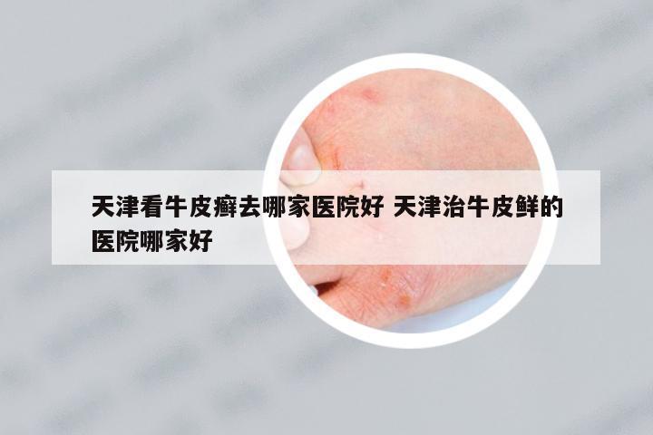 天津看牛皮癬去哪家醫(yī)院好 天津治牛皮鮮的醫(yī)院哪家好