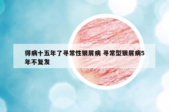 得病十五年了尋常性銀屑病 尋常型銀屑病5年不復(fù)發(fā)