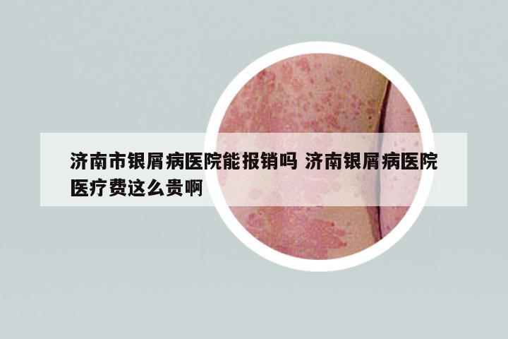 濟(jì)南市銀屑病醫(yī)院能報(bào)銷嗎 濟(jì)南銀屑病醫(yī)院醫(yī)療費(fèi)這么貴啊