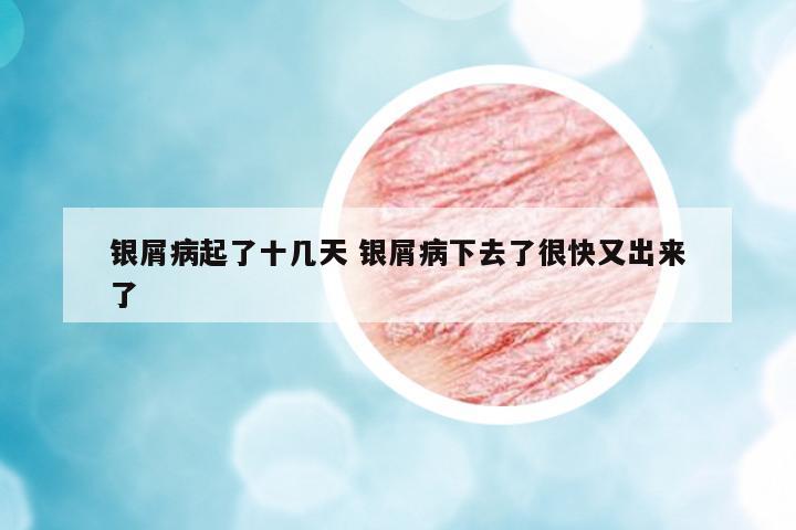 銀屑病起了十幾天 銀屑病下去了很快又出來了