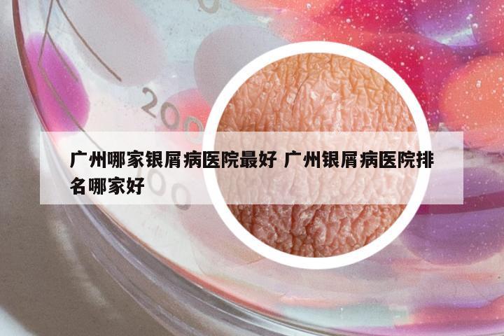 廣州哪家銀屑病醫(yī)院最好 廣州銀屑病醫(yī)院排名哪家好