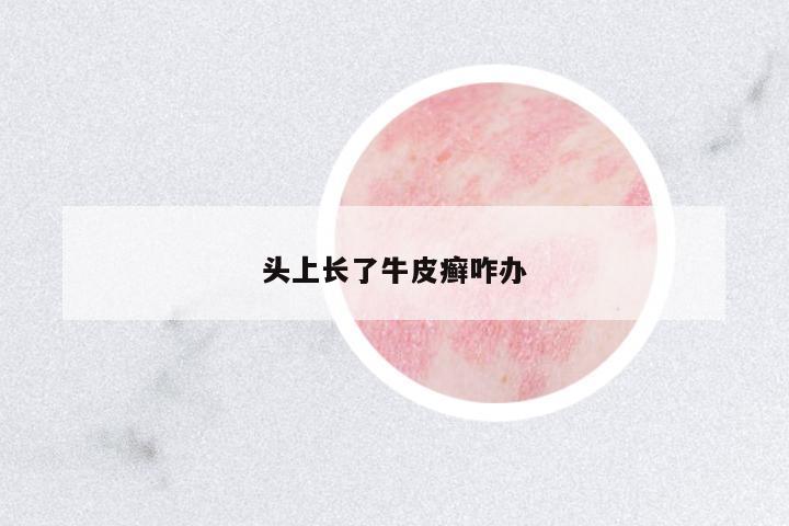 頭上長了牛皮癬咋辦