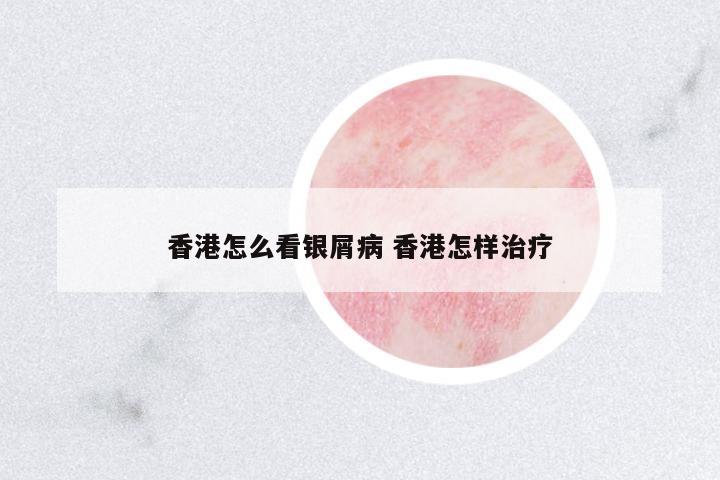 香港怎么看銀屑病 香港怎樣治療
