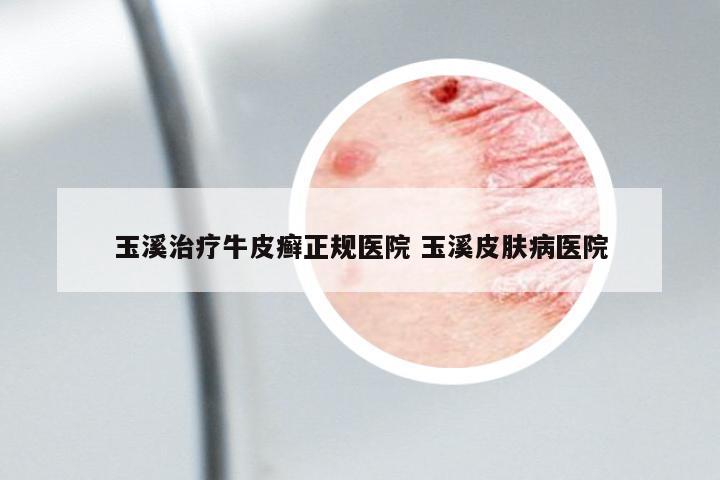 玉溪治療牛皮癬正規(guī)醫(yī)院 玉溪皮膚病醫(yī)院