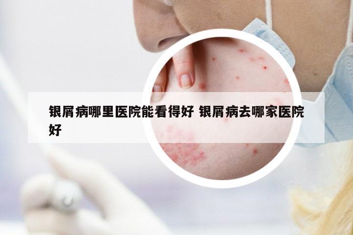 銀屑病哪里醫(yī)院能看得好 銀屑病去哪家醫(yī)院好