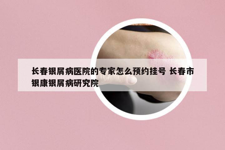 長春銀屑病醫(yī)院的專家怎么預約掛號 長春市銀康銀屑病研究院