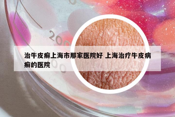 治牛皮癬上海市那家醫(yī)院好 上海治療牛皮病癬的醫(yī)院