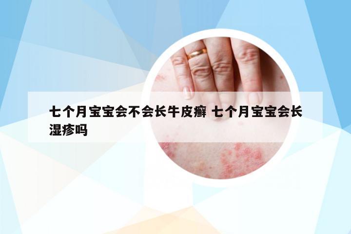 七個月寶寶會不會長牛皮癬 七個月寶寶會長濕疹嗎