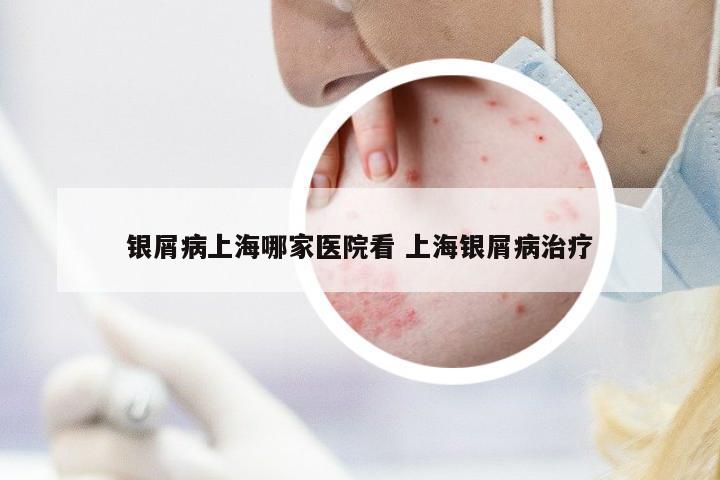 銀屑病上海哪家醫(yī)院看 上海銀屑病治療