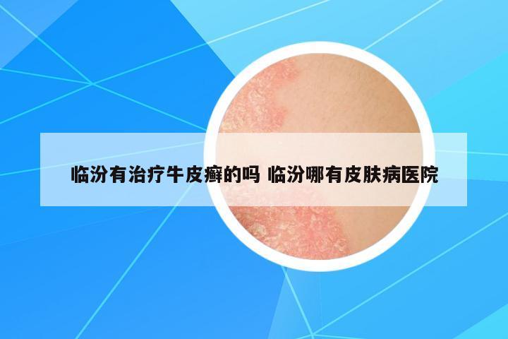 臨汾有治療牛皮癬的嗎 臨汾哪有皮膚病醫(yī)院