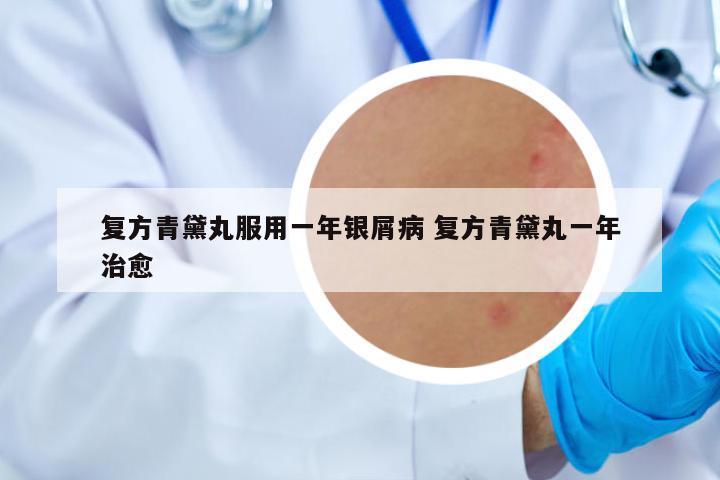 復(fù)方青黛丸服用一年銀屑病 復(fù)方青黛丸一年治愈