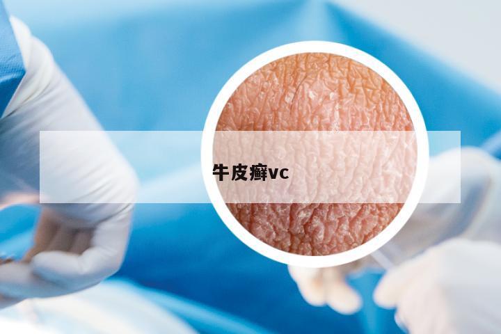 牛皮癬vc