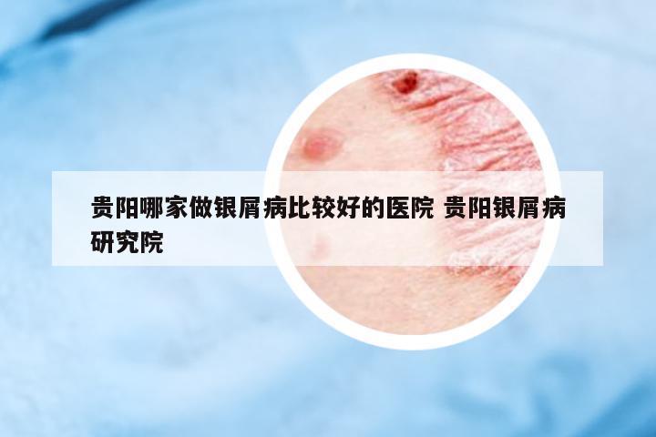 貴陽哪家做銀屑病比較好的醫(yī)院 貴陽銀屑病研究院