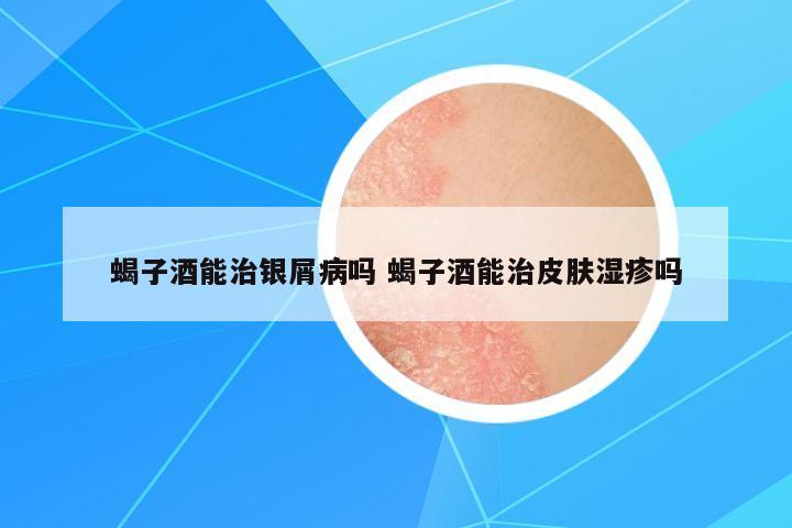蝎子酒能治銀屑病嗎 蝎子酒能治皮膚濕疹嗎