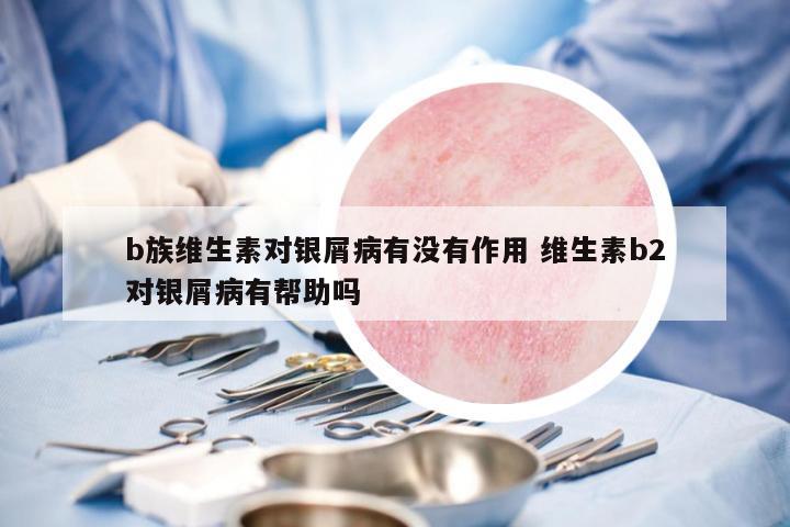 b族維生素對銀屑病有沒有作用 維生素b2對銀屑病有幫助嗎