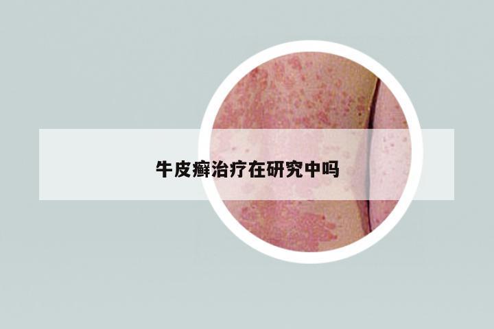牛皮癬治療在研究中嗎