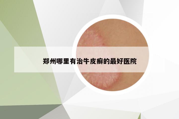 鄭州哪里有治牛皮癬的最好醫(yī)院