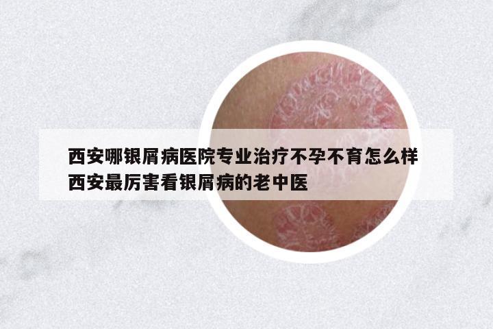 西安哪銀屑病醫(yī)院專業(yè)治療不孕不育怎么樣 西安最厲害看銀屑病的老中醫(yī)