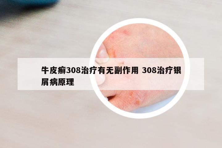 牛皮癬308治療有無副作用 308治療銀屑病原理