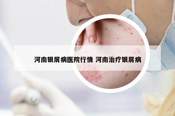 河南銀屑病醫(yī)院行情 河南治療銀屑病