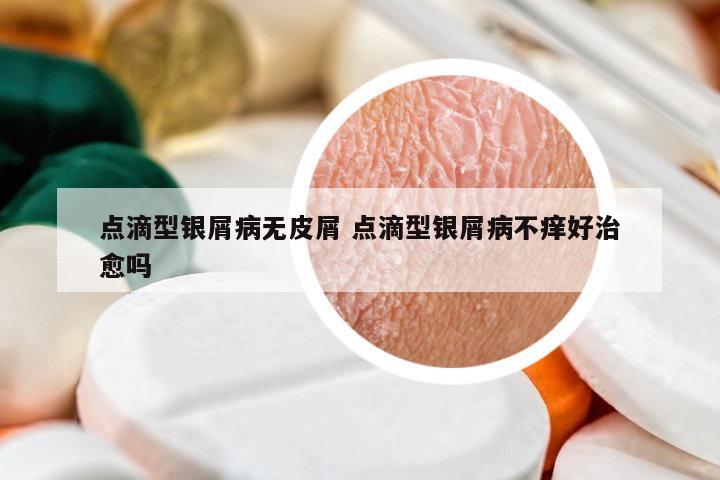 點滴型銀屑病無皮屑 點滴型銀屑病不癢好治愈嗎