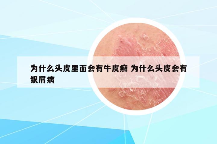 為什么頭皮里面會有牛皮癬 為什么頭皮會有銀屑病
