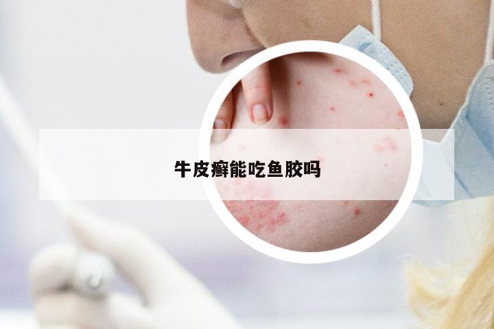 牛皮癬能吃魚膠嗎