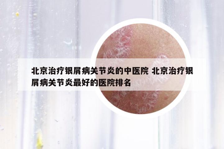 北京治療銀屑病關節(jié)炎的中醫(yī)院 北京治療銀屑病關節(jié)炎最好的醫(yī)院排名
