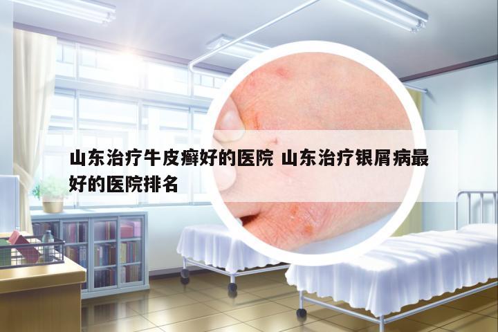 山東治療牛皮癬好的醫(yī)院 山東治療銀屑病最好的醫(yī)院排名