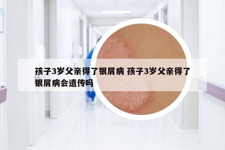 孩子3歲父親得了銀屑病 孩子3歲父親得了銀屑病會遺傳嗎