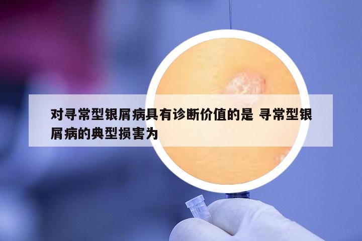 對尋常型銀屑病具有診斷價值的是 尋常型銀屑病的典型損害為