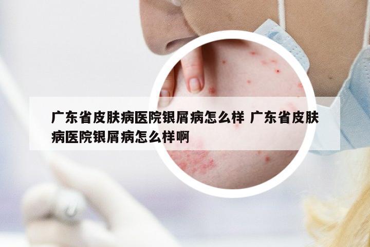 廣東省皮膚病醫(yī)院銀屑病怎么樣 廣東省皮膚病醫(yī)院銀屑病怎么樣啊