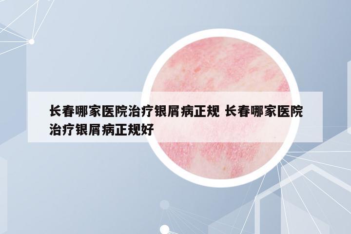 長春哪家醫(yī)院治療銀屑病正規(guī) 長春哪家醫(yī)院治療銀屑病正規(guī)好