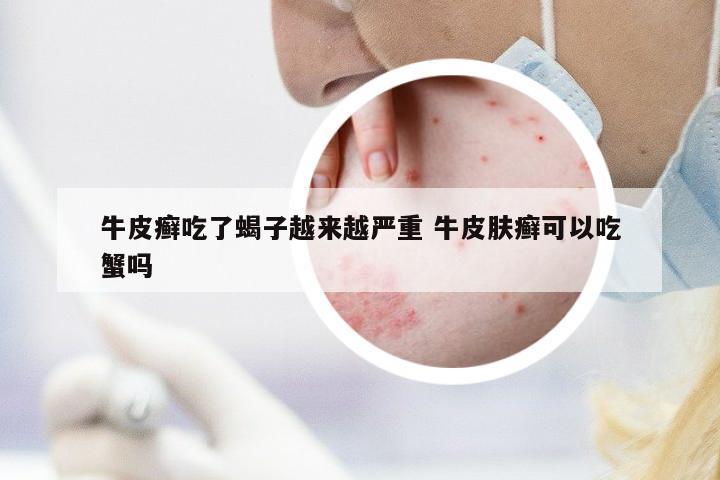 牛皮癬吃了蝎子越來越嚴(yán)重 牛皮膚癬可以吃蟹嗎