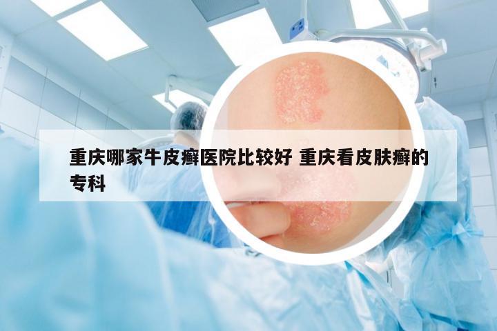 重慶哪家牛皮癬醫(yī)院比較好 重慶看皮膚癬的專科